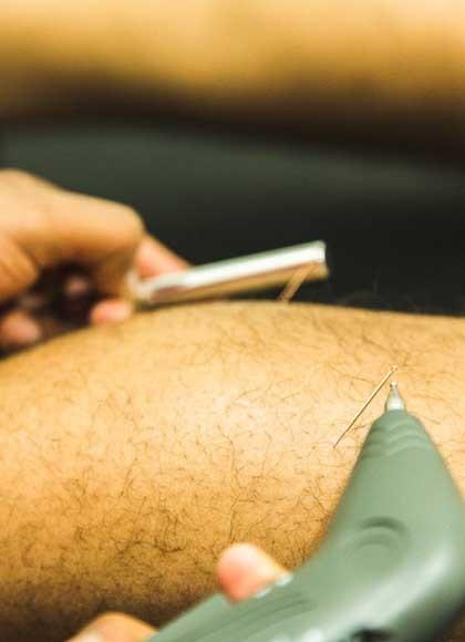 Intramuscular Stimulation (IMS)